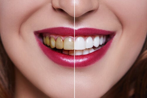 Causas de los dientes manchados