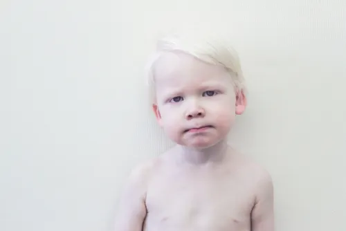 niño albino