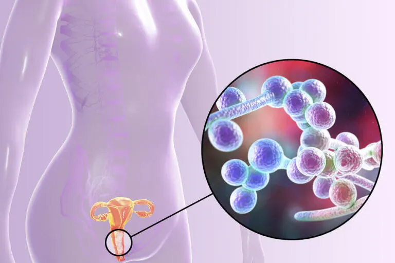 ¿Conoces el test para saber si tienes candidiasis?