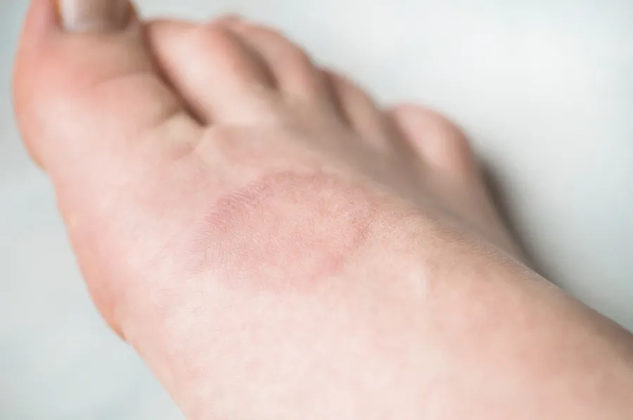 ¿Qué es el granuloma anular?