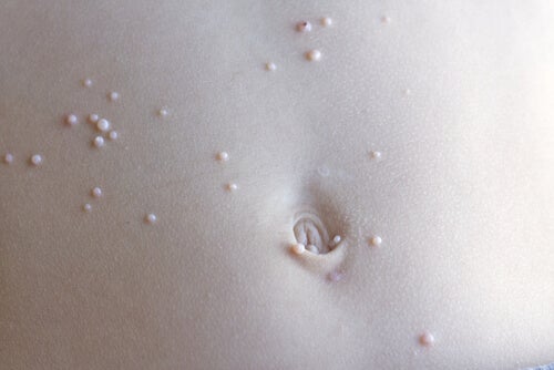 lesiones en abdomen por molluscum contagiosum