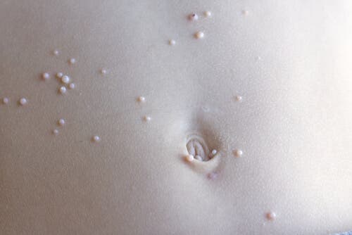 Lésions abdominales dues au molluscum contagiosum.