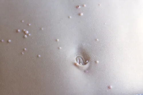 Lésions abdominales dues au molluscum contagiosum.