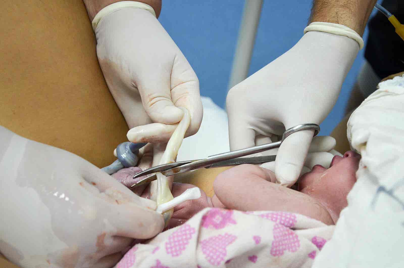 El ombligo del recién nacido requiere cuidados.