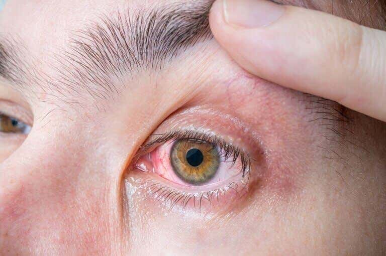 Melanoma ocular: síntomas y causas