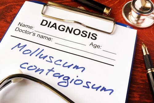 Molluscum contagiosum.