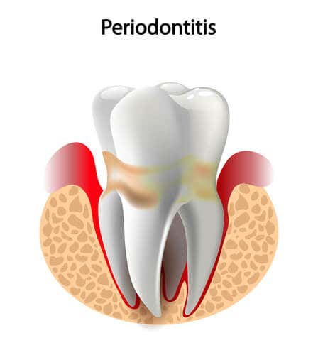 periodontitis y fertilidad