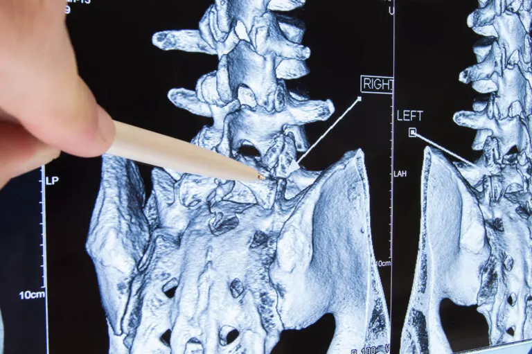 Radiculopatía: causas, síntomas y tratamiento