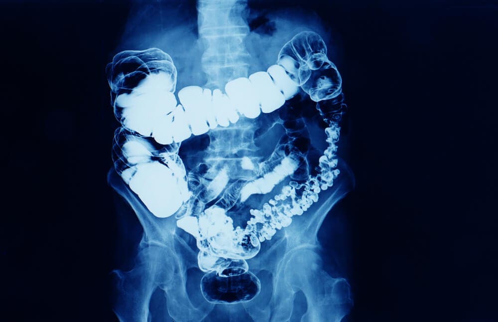 Cáncer de colon