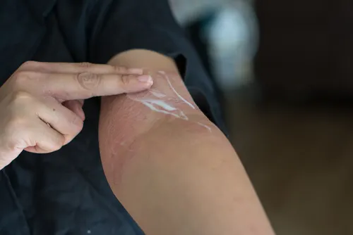 cremas para enfermedades de la piel