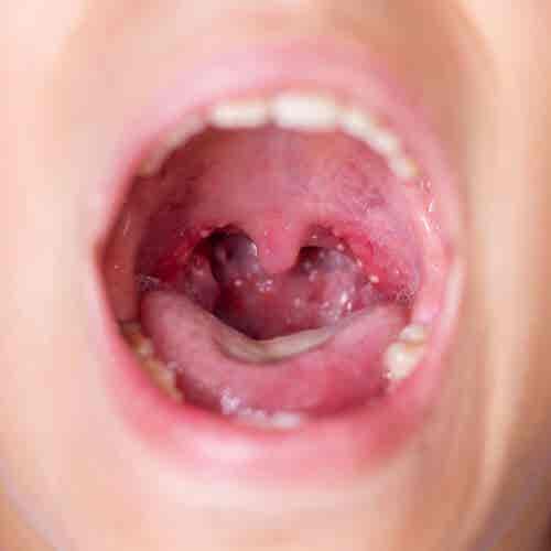 faringitis en un niño