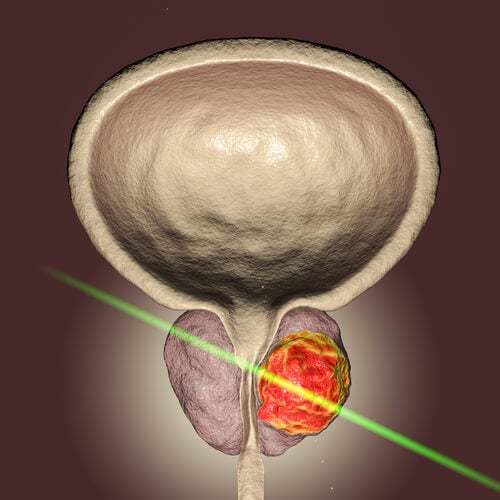 El láser prostático: un avance de la ciencia para la cirugía de próstata