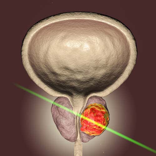 El láser prostático: un avance de la ciencia para la cirugía de próstata
