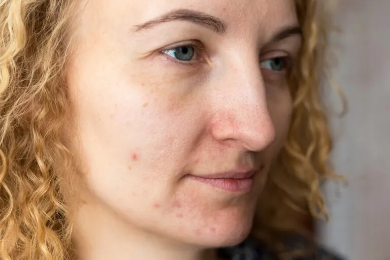 Cómo prevenir el melasma
