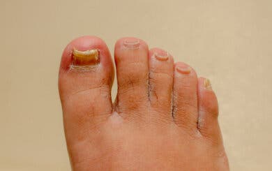 Remedios para la onicomicosis de manos y pies: ¿funcionan?