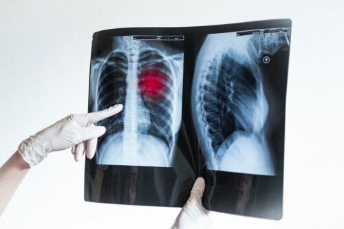Coágulos en los pulmones por coronavirus