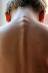 Mielitis transversa: síntomas, causas y tratamientos