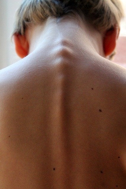 Mielitis transversa: síntomas, causas y tratamientos