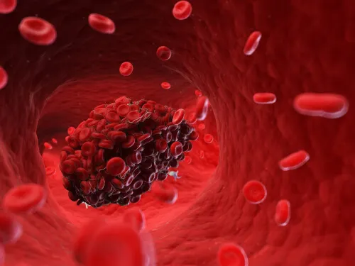 coágulo causa embolia cerebral