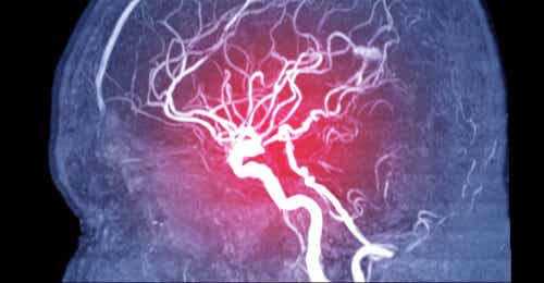 Embolia cerebral: síntomas, tipos y causas