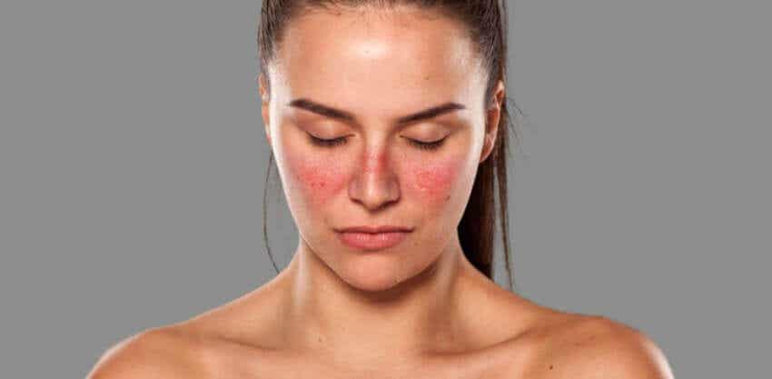 Beauty-Tipps bei Lupus - Frau mit geröteter Haut
