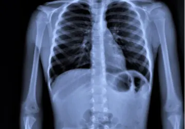¿Cómo afecta la neumonía en el cuerpo?