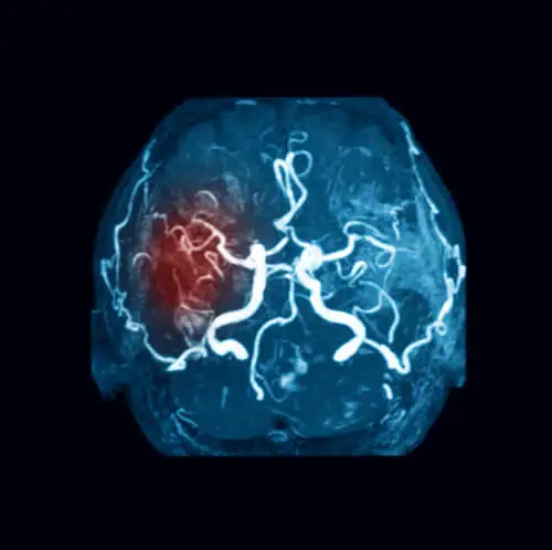 estudio de coágulos en el cerebro