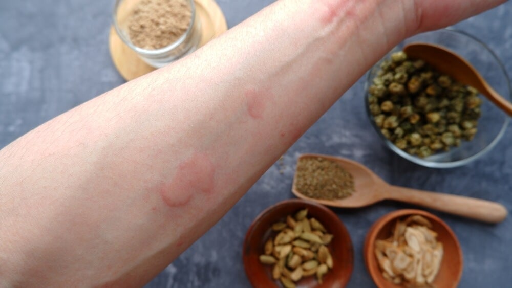 Alergia a las especias: ¿cómo saberlo?