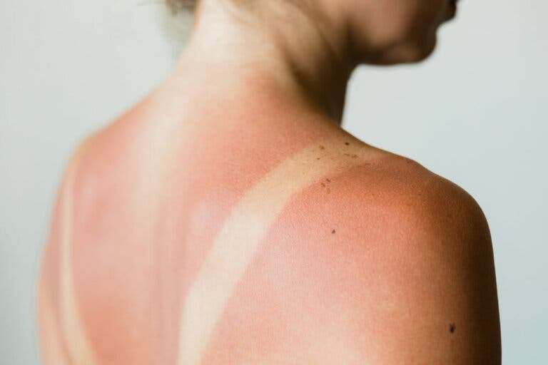 Eritema solar: recomendaciones y cuidados
