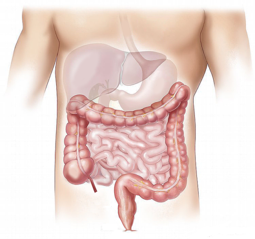 El síndrome del intestino corto