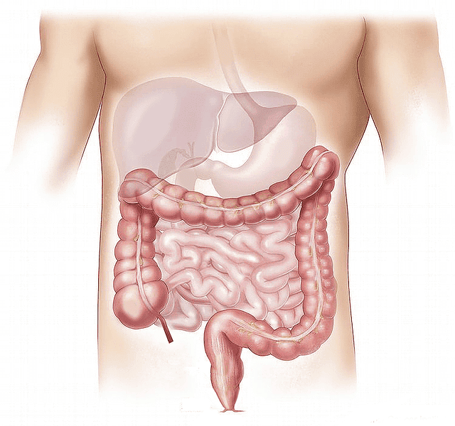 El síndrome del intestino corto