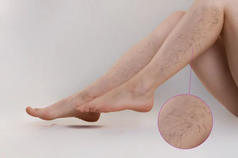 Tratamientos de las lesiones vasculares