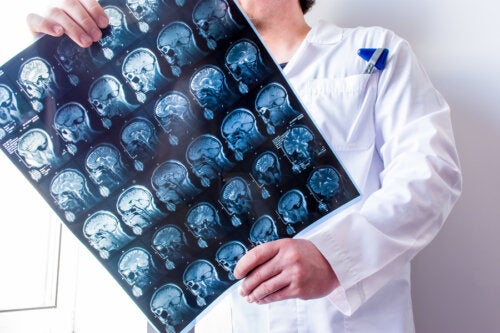 ¿Qué diferencia hay entre ELA y esclerosis múltiple?