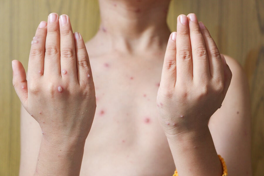 ¿Aumentan los casos de varicela en primavera?