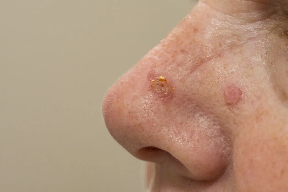 Queratosis actínicas