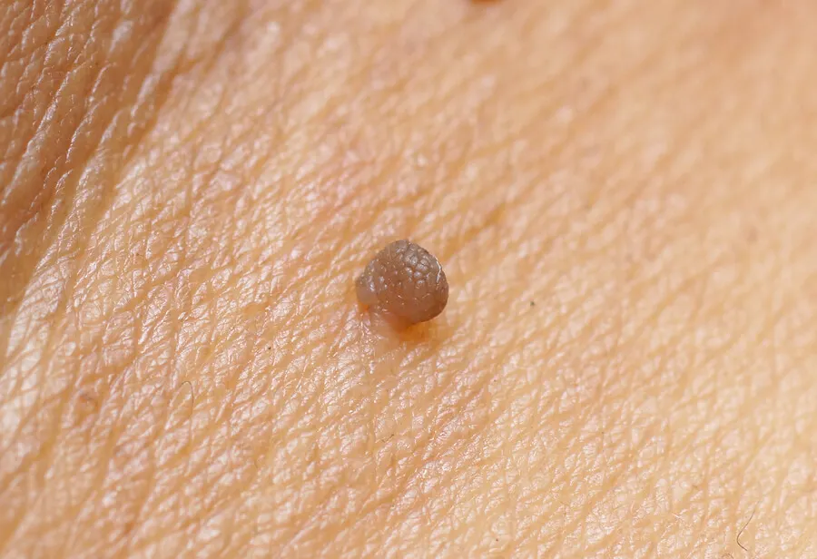 Queratosis seborreica