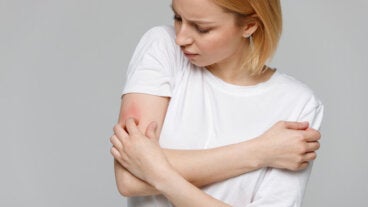 Alergia al frío: síntomas y recomendaciones