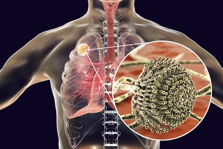 Aspergilosis y hongos en los pulmones