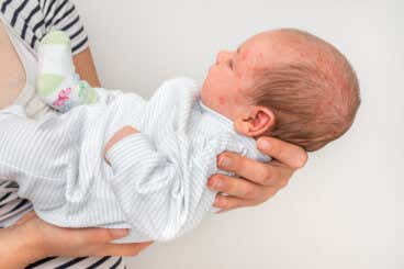 Escarlatina en bebés: ¿cómo tratarla?