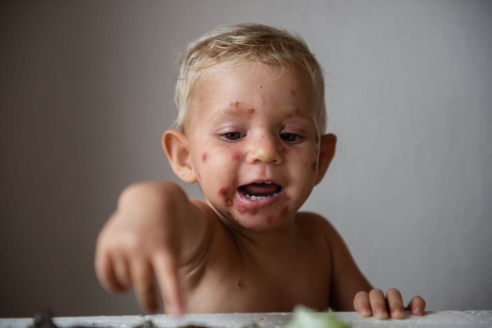 Impetigo bij kinderen