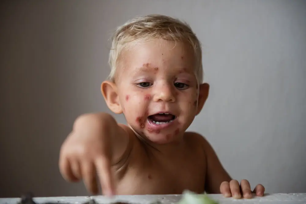 Diagnóstico del impétigo en los niños