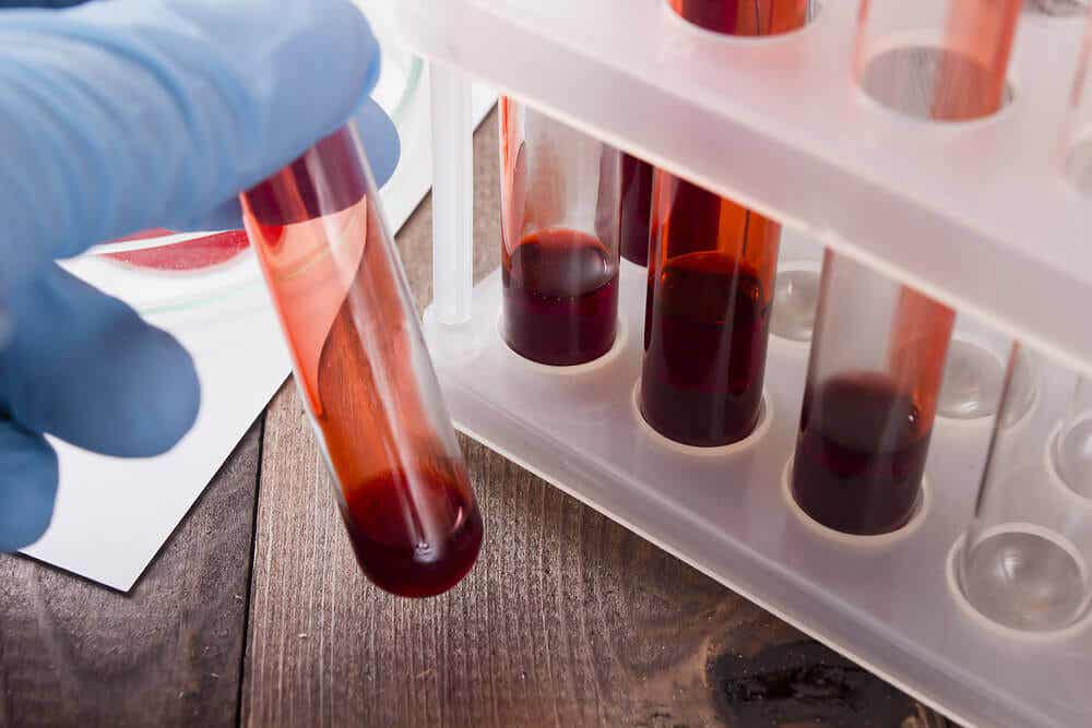 Examen de sangre para hepatitis infantil aguda.