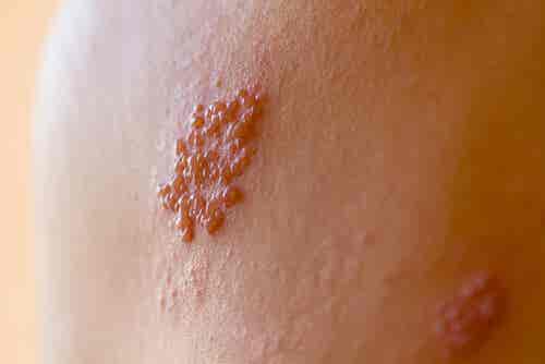 Ampollas herpes zóster en la espalda