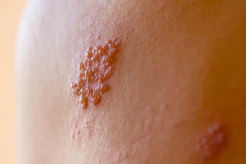 Ampollas herpes zóster en la espalda