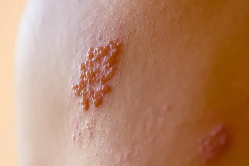 Ampollas herpes zóster en la espalda