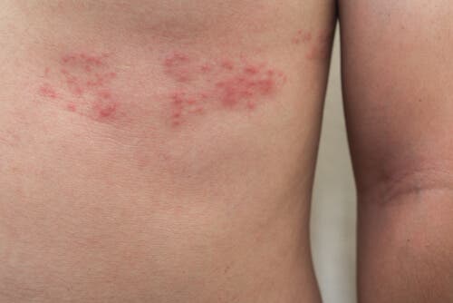 Lesiones de la culebrilla