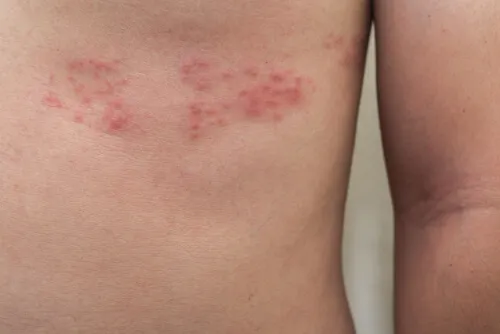 Lesiones de la culebrilla