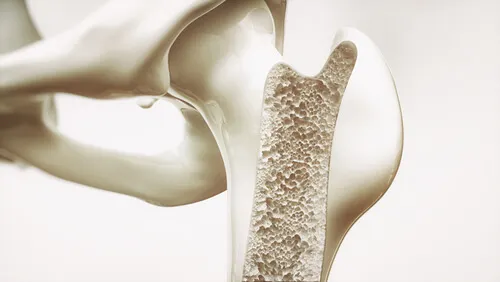 Densidad ósea y tipos de osteoporosis