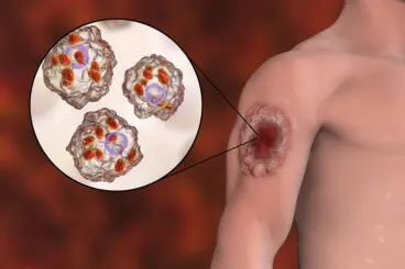 Leishmaniasis en humanos: síntomas y tratamiento