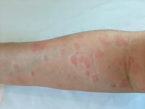 Causas del eritema